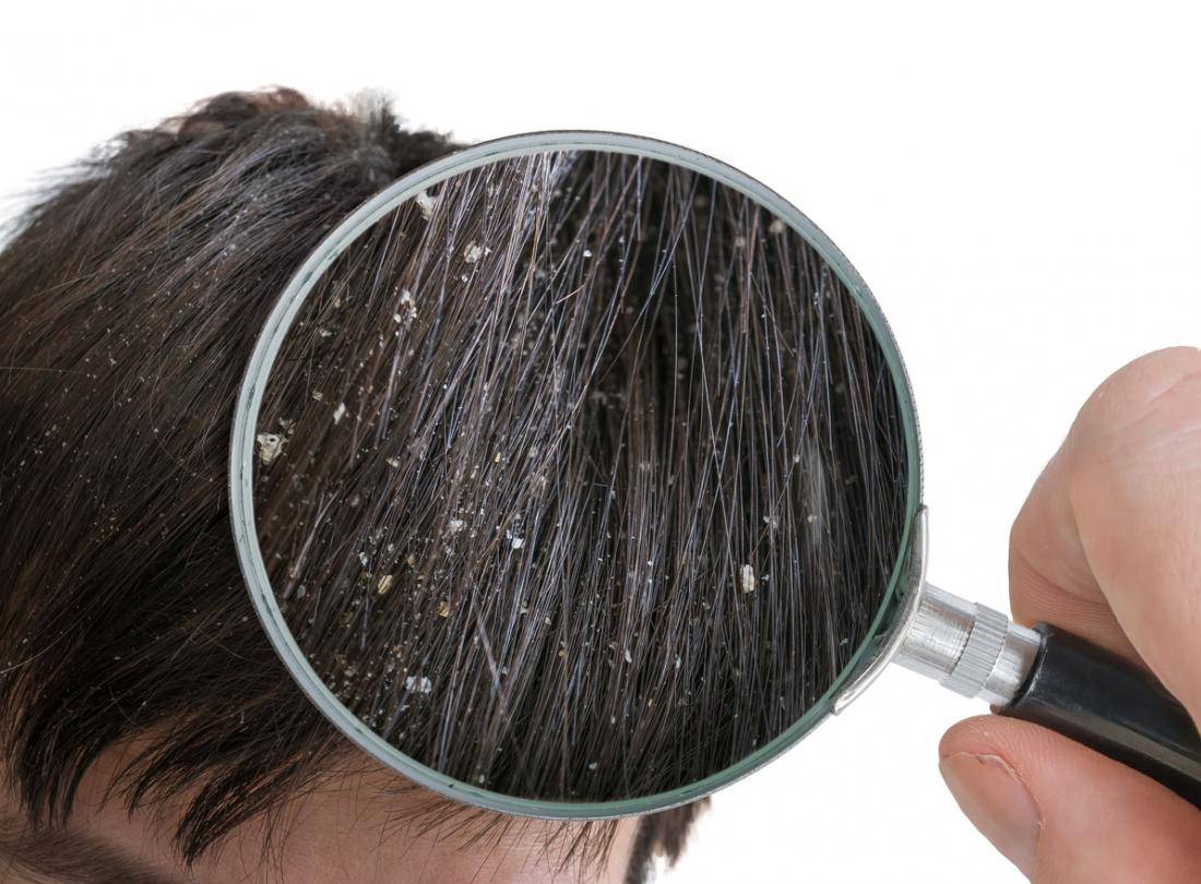 درمان شوره سر بدون نیاز به مواد شیمیایی